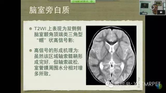 【PPT】脑小血管病影像与临床