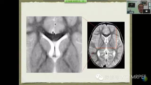 【PPT】脑小血管病影像与临床