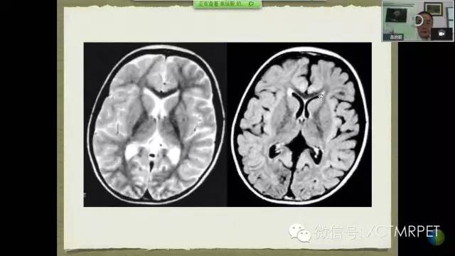 【PPT】脑小血管病影像与临床