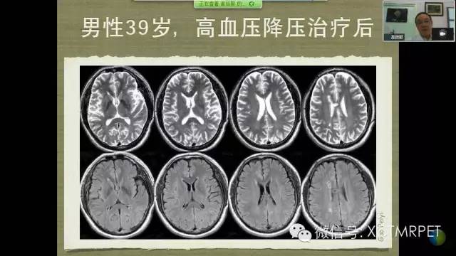 【PPT】脑小血管病影像与临床