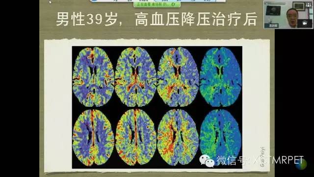 【PPT】脑小血管病影像与临床
