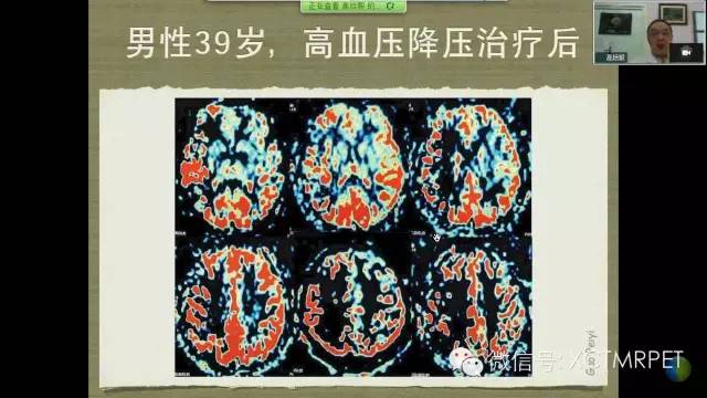 【PPT】脑小血管病影像与临床