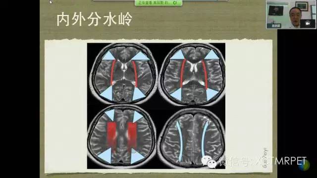 【PPT】脑小血管病影像与临床