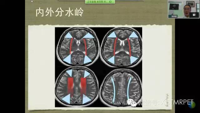 【PPT】脑小血管病影像与临床