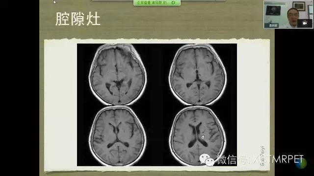 【PPT】脑小血管病影像与临床
