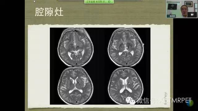 【PPT】脑小血管病影像与临床