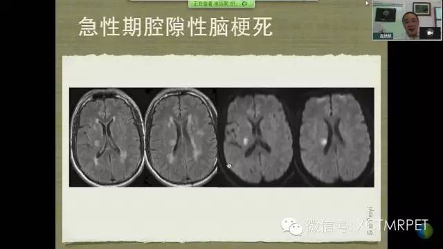 【PPT】脑小血管病影像与临床