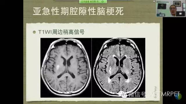 【PPT】脑小血管病影像与临床