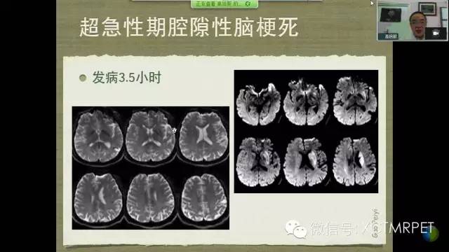 【PPT】脑小血管病影像与临床