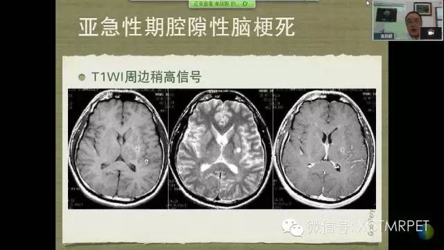 【PPT】脑小血管病影像与临床