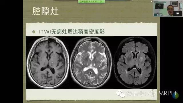 【PPT】脑小血管病影像与临床