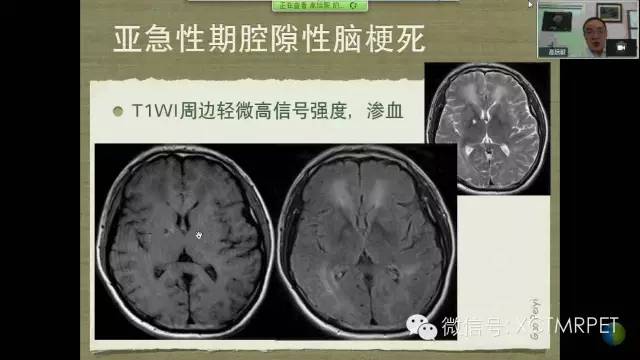 【PPT】脑小血管病影像与临床