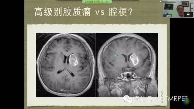 【PPT】脑小血管病影像与临床