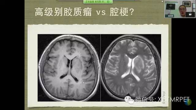 【PPT】脑小血管病影像与临床