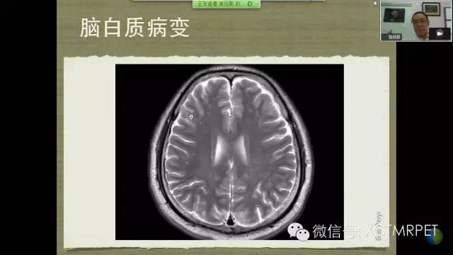 【PPT】脑小血管病影像与临床