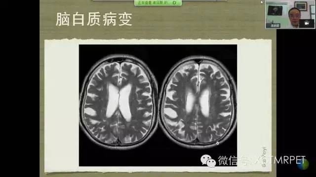 【PPT】脑小血管病影像与临床