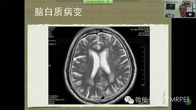 【PPT】脑小血管病影像与临床