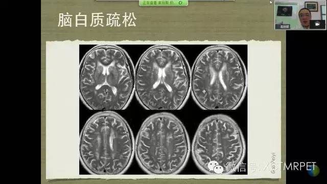 【PPT】脑小血管病影像与临床