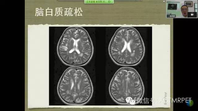 【PPT】脑小血管病影像与临床