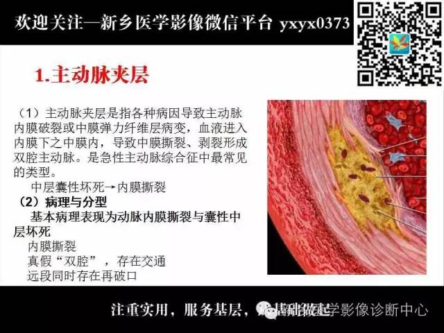 【PPT】主动脉病变影像诊断和鉴别诊断
