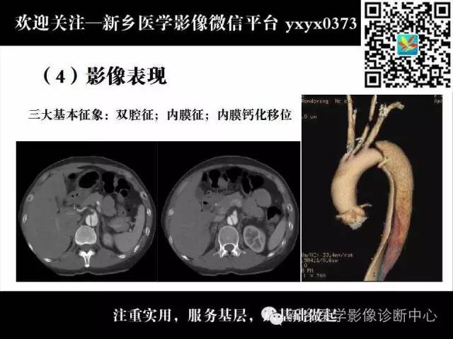 【PPT】主动脉病变影像诊断和鉴别诊断