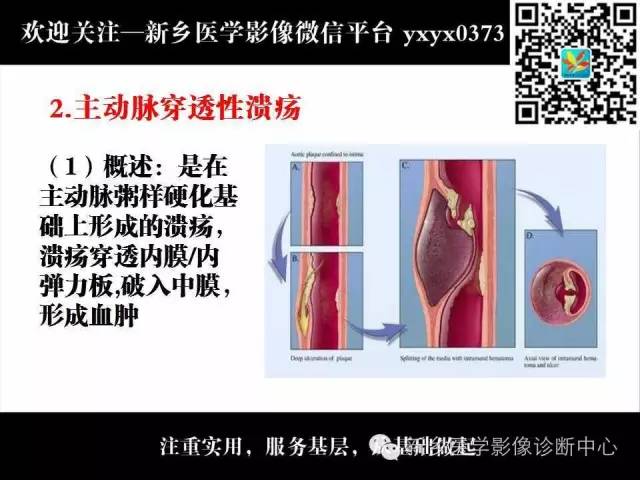 【PPT】主动脉病变影像诊断和鉴别诊断