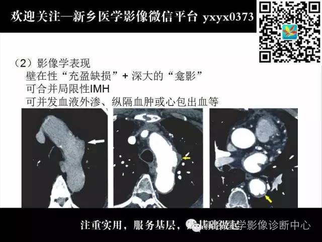 【PPT】主动脉病变影像诊断和鉴别诊断