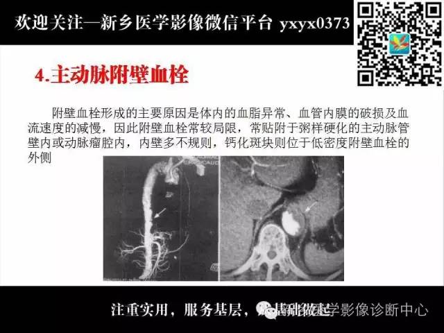 【PPT】主动脉病变影像诊断和鉴别诊断