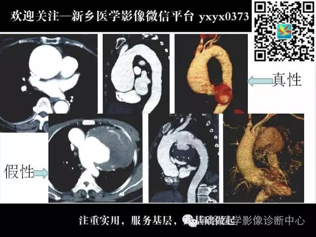 【PPT】主动脉病变影像诊断和鉴别诊断