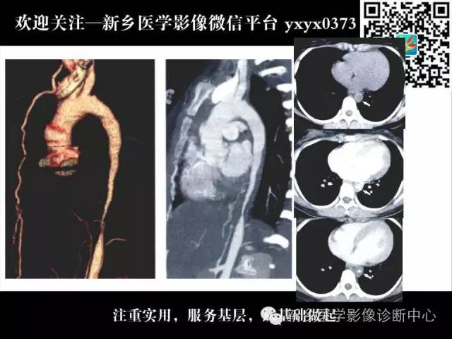 【PPT】主动脉病变影像诊断和鉴别诊断