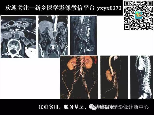 【PPT】主动脉病变影像诊断和鉴别诊断