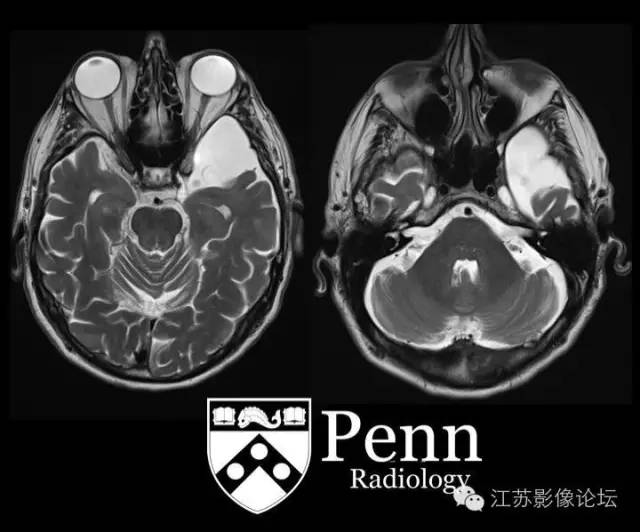 【双语病例】左颞部蛛网膜囊肿1例MR