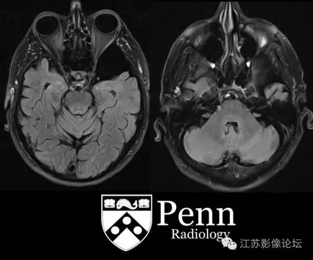 【双语病例】左颞部蛛网膜囊肿1例MR 【双语病例】左颞部蛛网膜囊肿1例MR