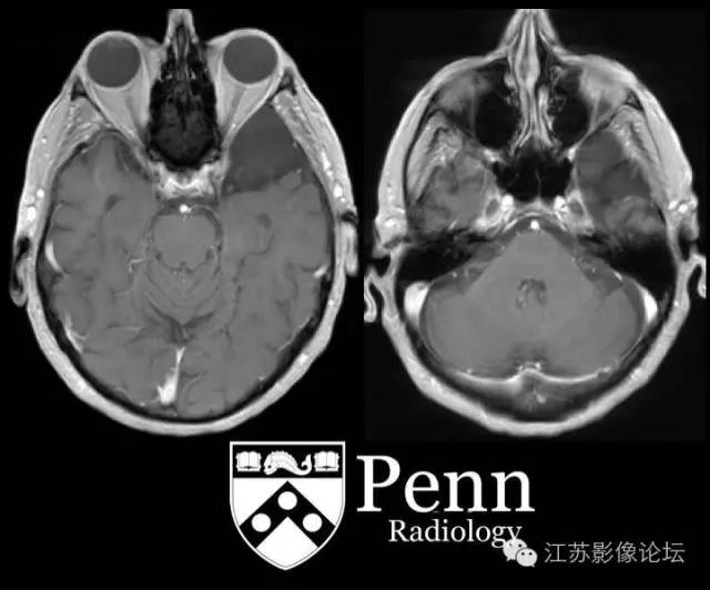 【双语病例】左颞部蛛网膜囊肿1例MR 【双语病例】左颞部蛛网膜囊肿1例MR