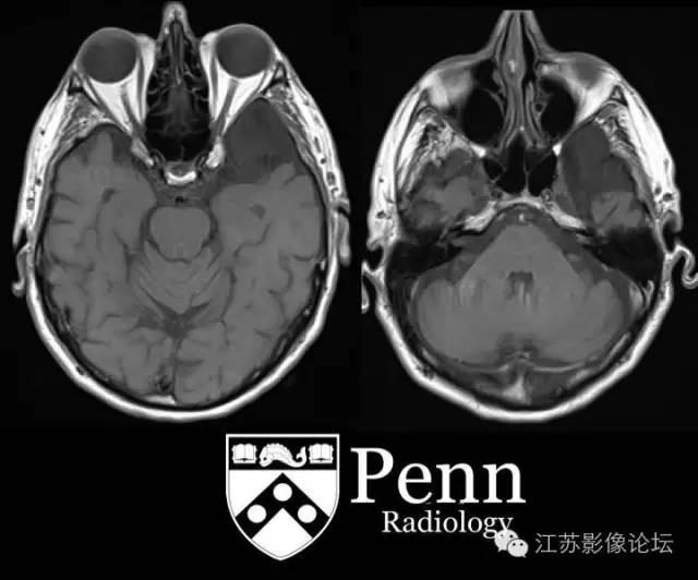 【双语病例】左颞部蛛网膜囊肿1例MR 【双语病例】左颞部蛛网膜囊肿1例MR
