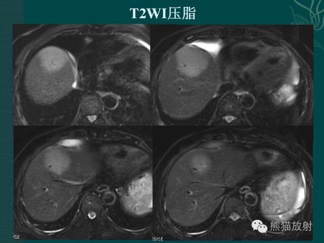 【病例】肝脏原发性淋巴瘤1例MR影像表现