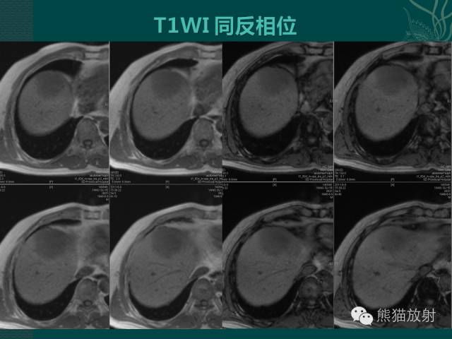 【病例】肝脏原发性淋巴瘤1例MR影像表现