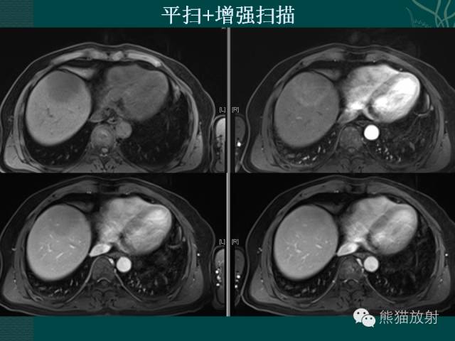 【病例】肝脏原发性淋巴瘤1例MR影像表现