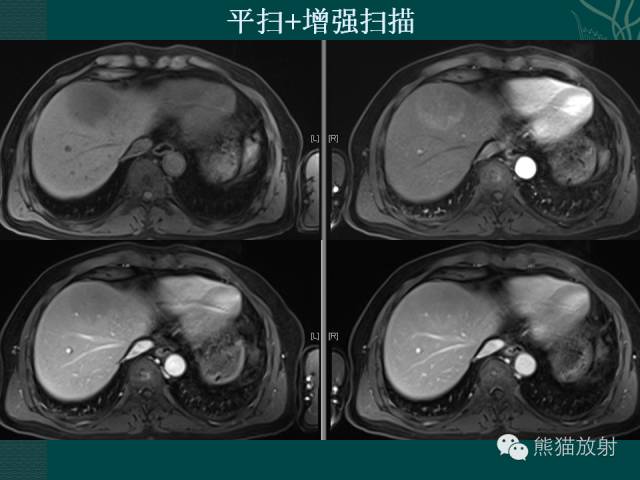 【病例】肝脏原发性淋巴瘤1例MR影像表现