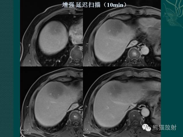 【病例】肝脏原发性淋巴瘤1例MR影像表现