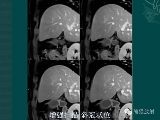 【病例】肝脏原发性淋巴瘤1例MR影像表现