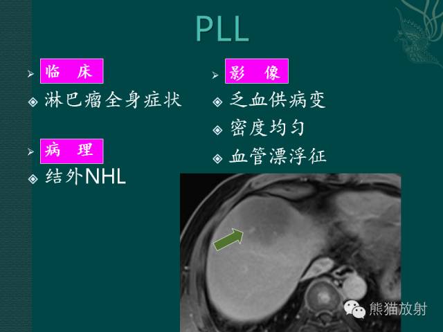 【病例】肝脏原发性淋巴瘤1例MR影像表现
