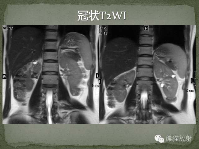 【病例】左肾下极血管周细胞瘤1例MR影像表现