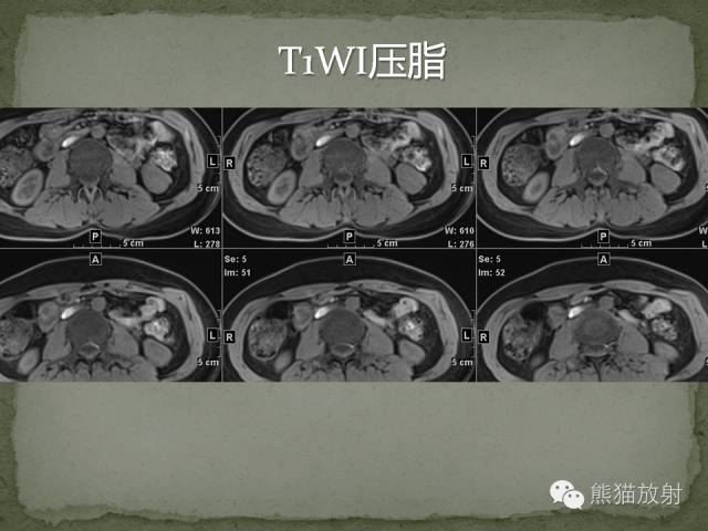 【病例】左肾下极血管周细胞瘤1例MR影像表现
