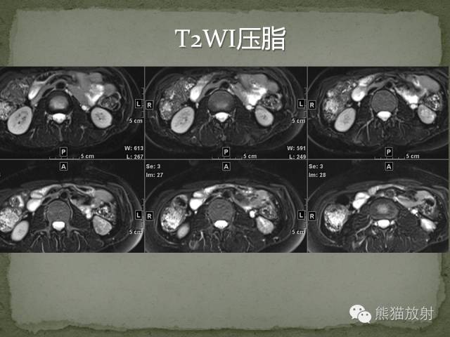 【病例】左肾下极血管周细胞瘤1例MR影像表现