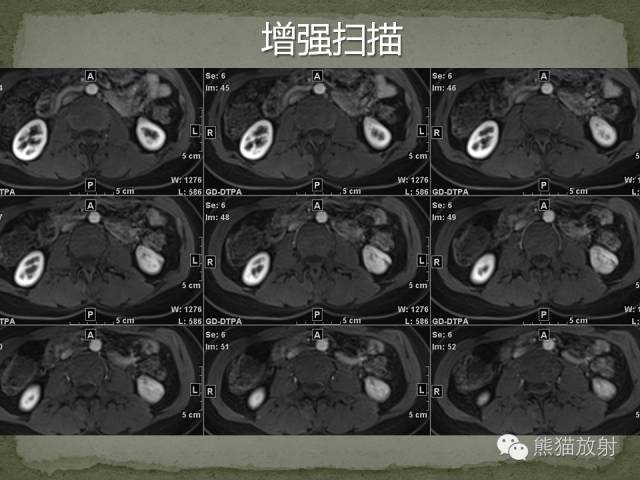 【病例】左肾下极血管周细胞瘤1例MR影像表现