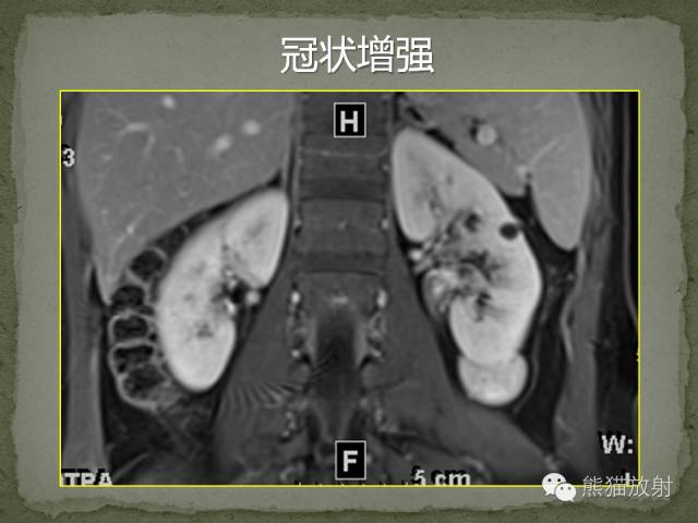 【病例】左肾下极血管周细胞瘤1例MR影像表现