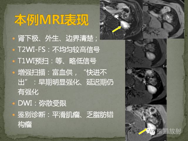 【病例】左肾下极血管周细胞瘤1例MR影像表现