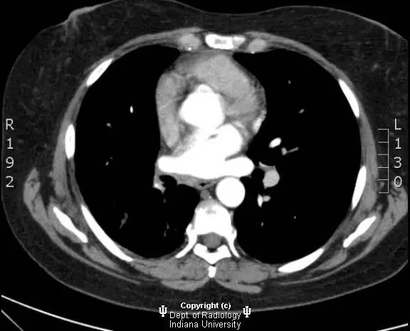 【病例】纤维性纵膈炎1例X线CT影像表现 【病例】纤维性纵膈炎1例X线CT影像表现