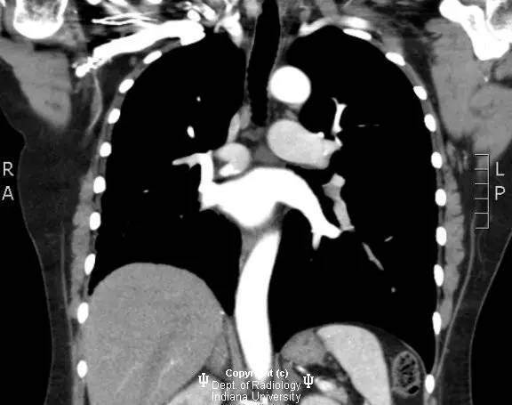 【病例】纤维性纵膈炎1例X线CT影像表现 【病例】纤维性纵膈炎1例X线CT影像表现